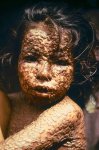 450px-Child_with_Smallpox_Bangladesh.jpg